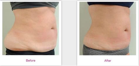what is velashape 3.